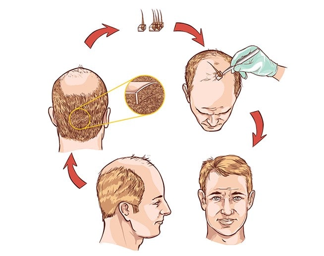 How to plan for a hair transplant procedure