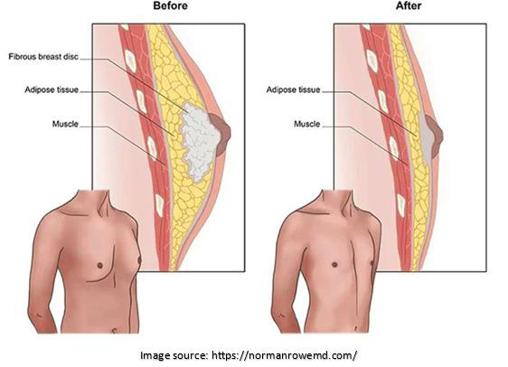 Gynaecomastia surgery