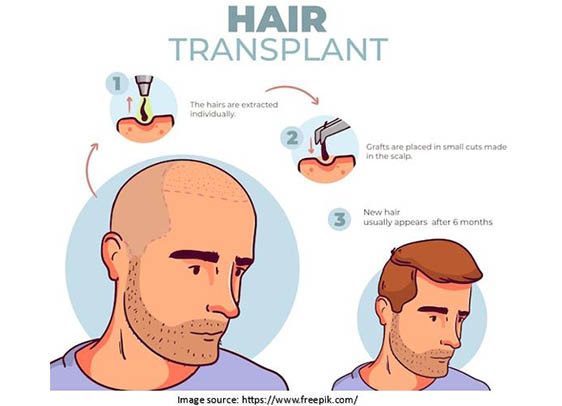 Hair Transplantation