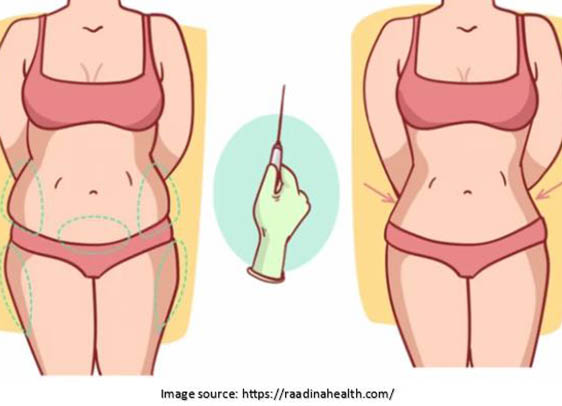 Liposuction