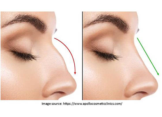 Rhinoplasty