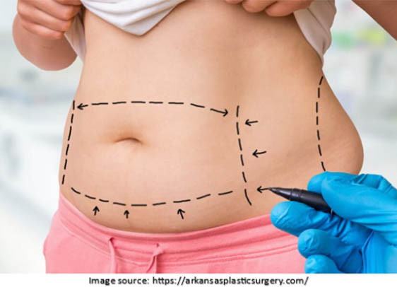 Tummy tuck