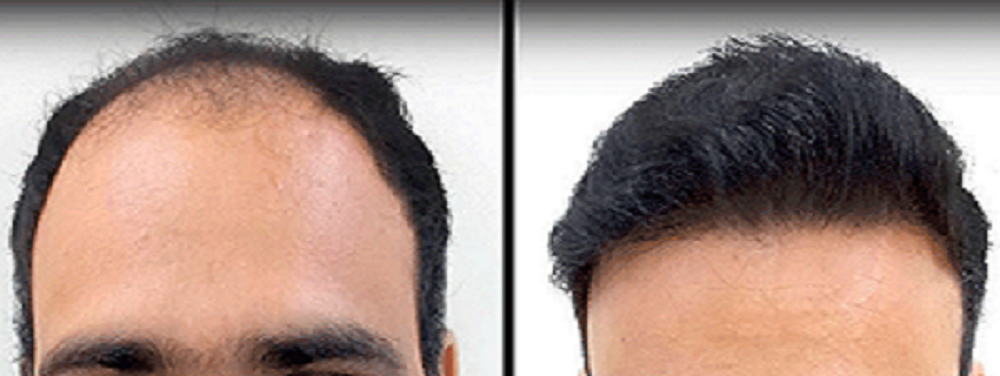 Hair Transplant